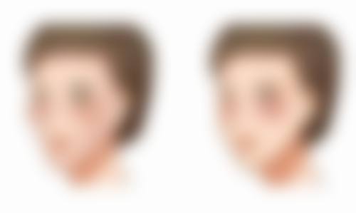 肉芽肿形成的后遗症