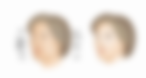 未成年人不能做抽脂手术