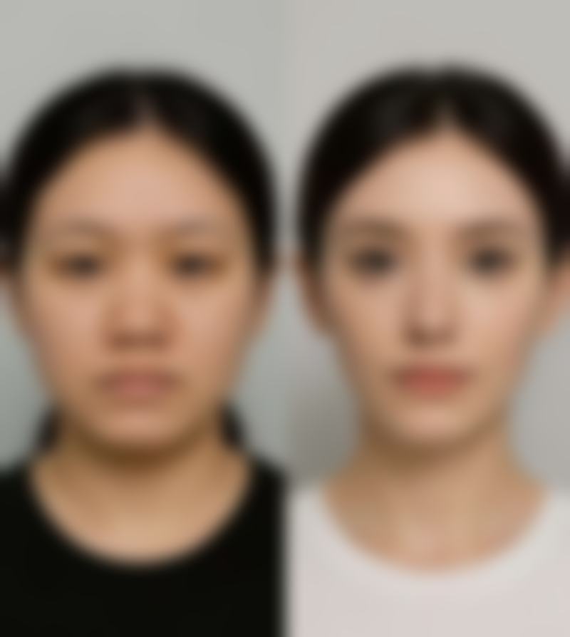 身体处于感染期的人不能做抽脂手术