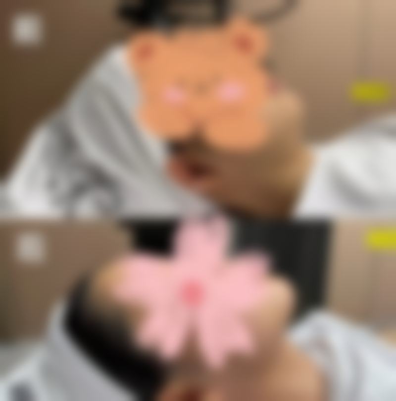 假体植入法快速丰太阳穴