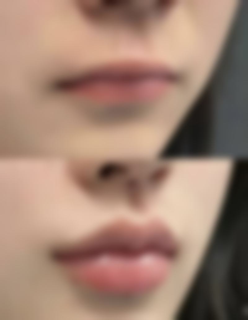 吸脂手术的危害有哪些？皮肤坏死、脏器损伤、心理问题又该如何避免