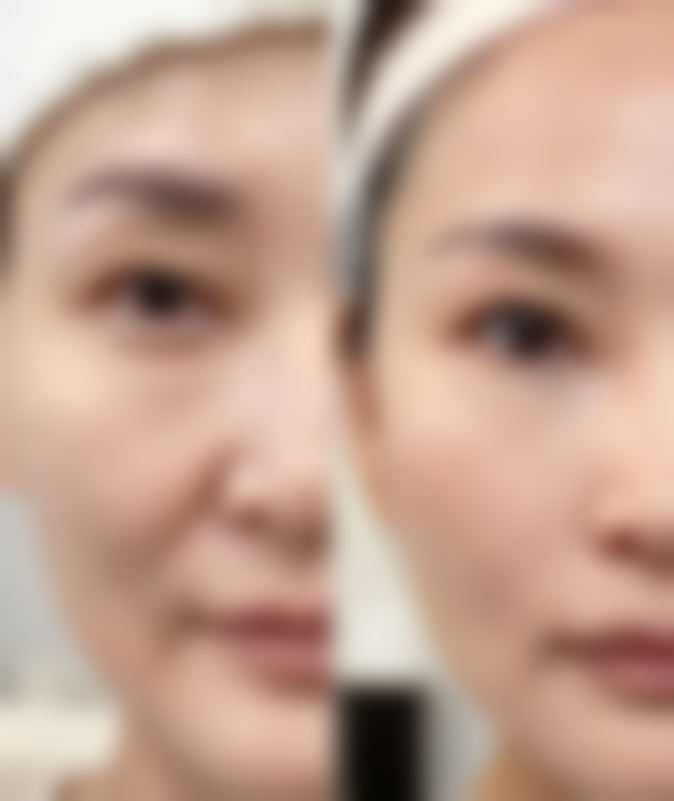 处于特殊生理期的女性不能做抽脂手术