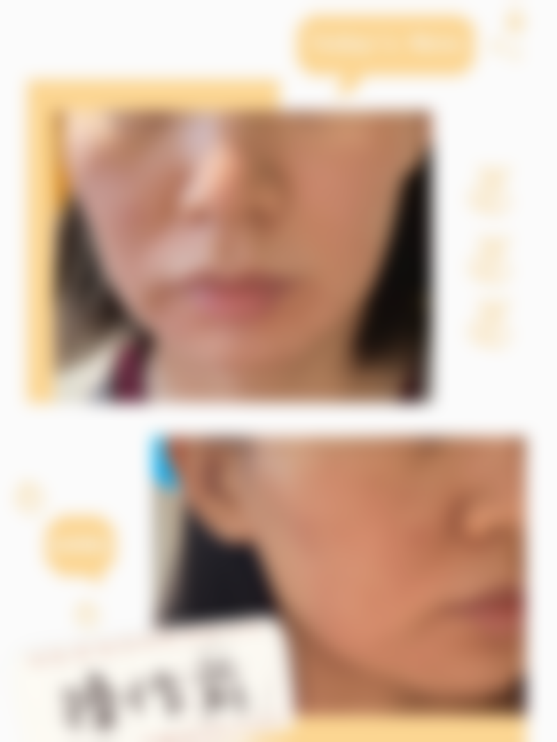 广东韩妃医院蒋水清主任推荐的半岛超声炮咋样？亲测中下面部松弛问题改善超明显！ 