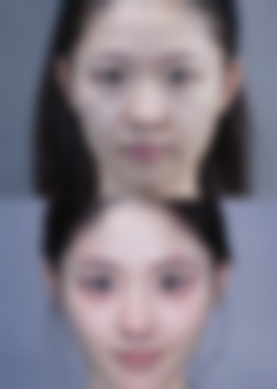 上嘴唇厚整形手术的价格大概是多少