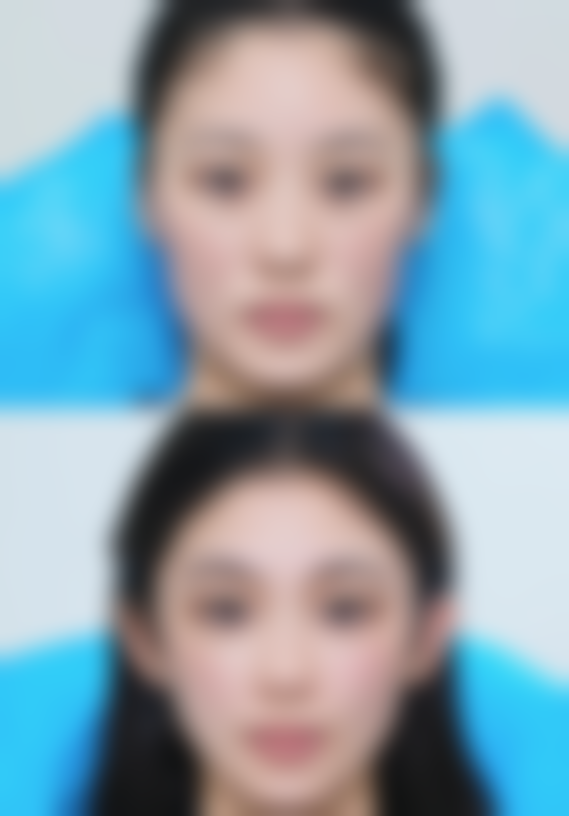 延长半肋骨隆鼻成效维持时间的方法