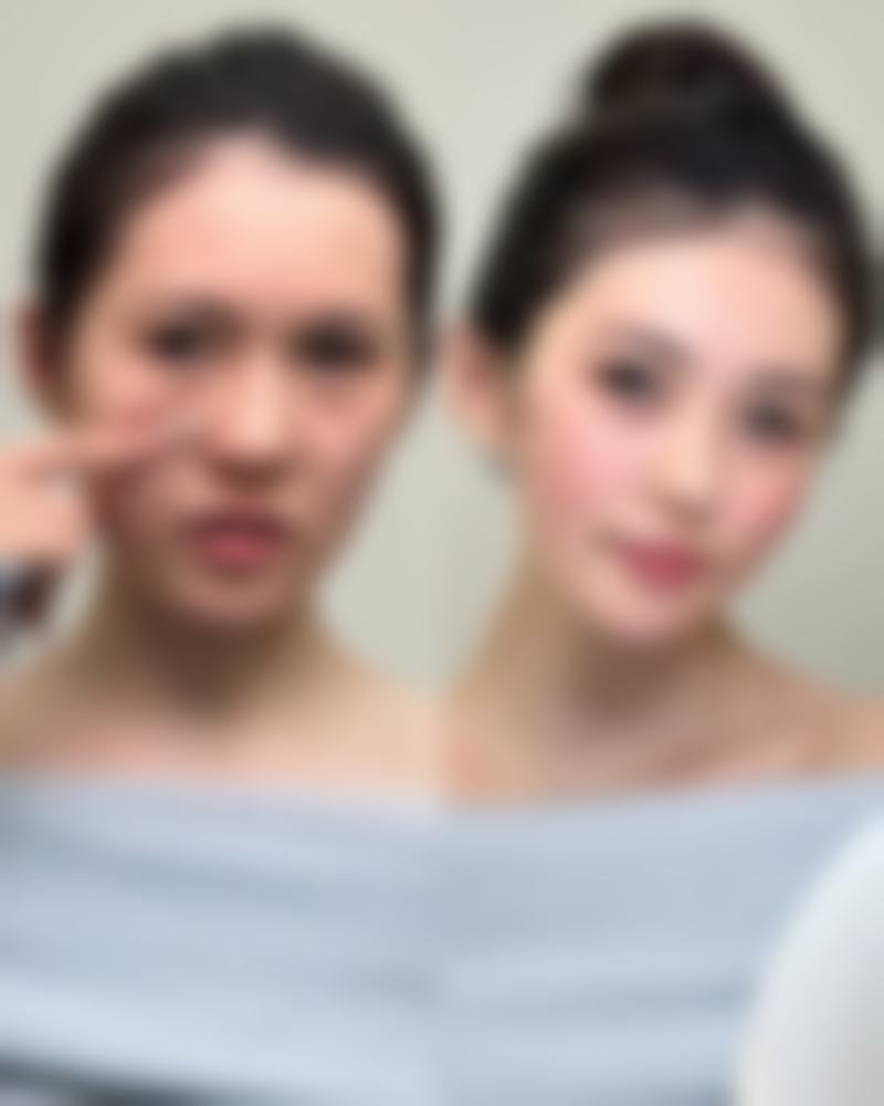 阴唇缩小手术的费用有差异