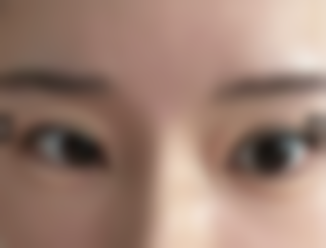 改善泪沟后的成效如何呢？