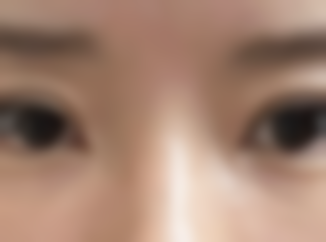 改善泪沟的项目体验过程是怎样的呢？