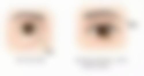 哪些人不适合爱贝芙隆鼻，盲目做会不安心吗？