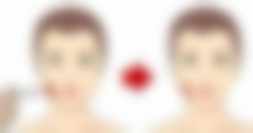 自体组织移植丰太阳穴