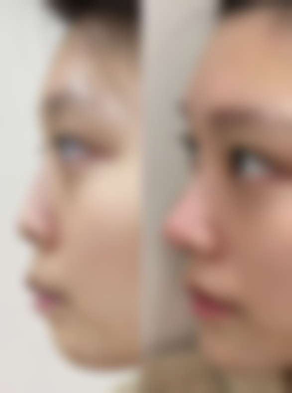 如何降低隆胸假体的危害