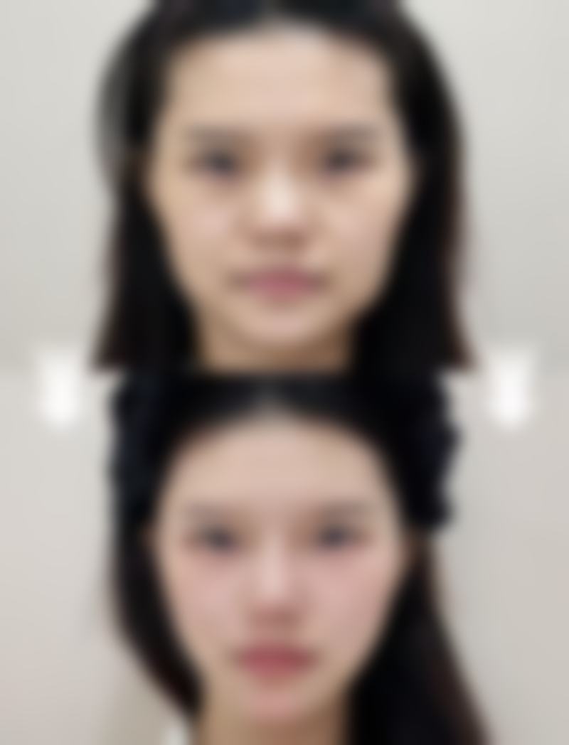 伊婉玻尿酸：自然又持久