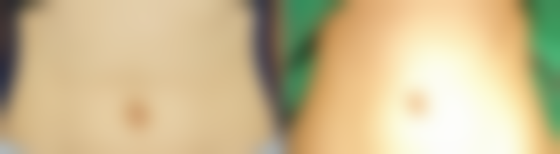 隆胸假体是否可以终身使用