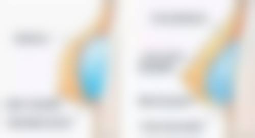 区分凸嘴类型选择合适方法