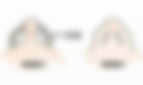 种植头发的毛囊提取过程