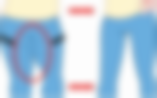 肋骨隆鼻鼻头都会硬吗？术后硬的原因、改善及避免方法你知道吗 