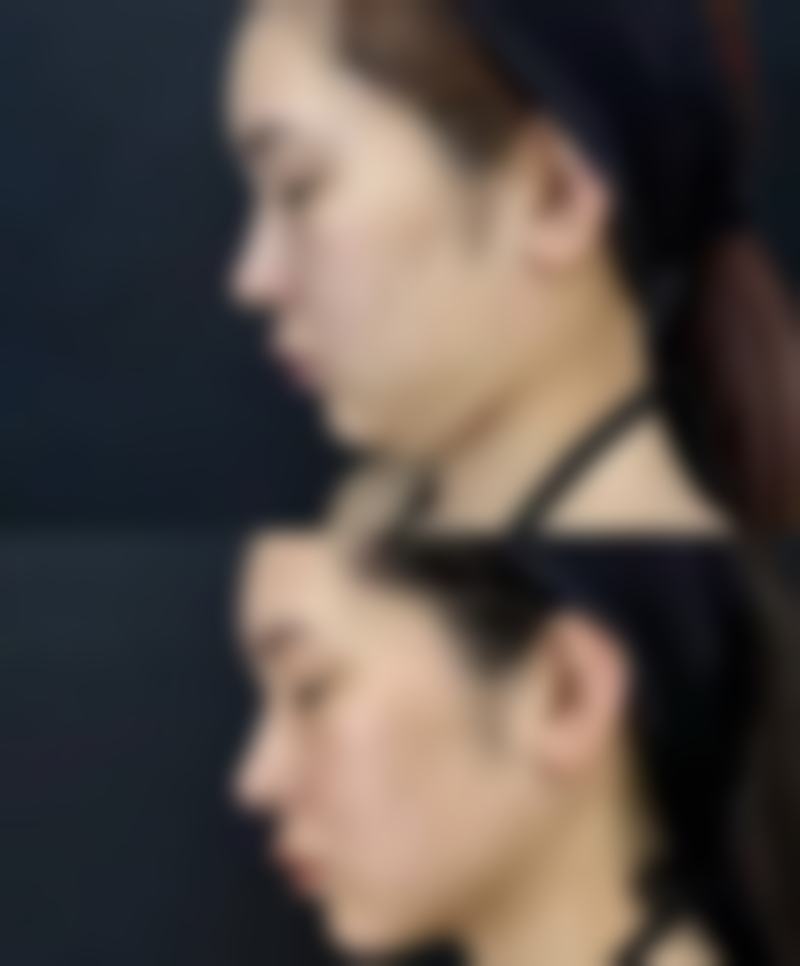 选择隆鼻方式时如何避免鼻头硬