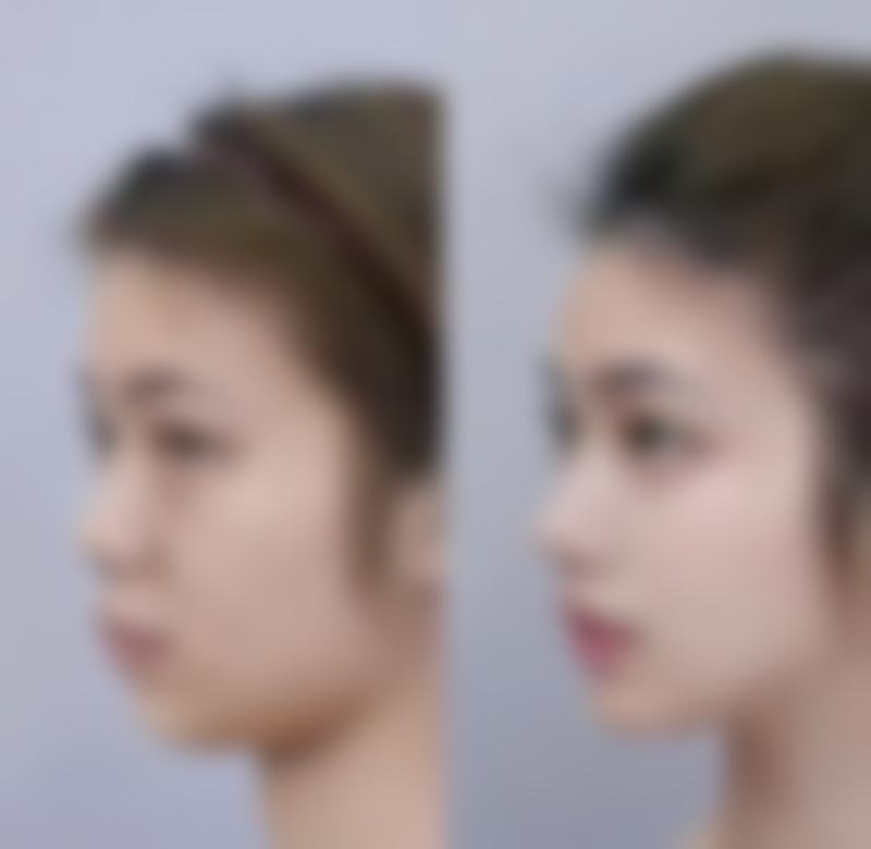 种植头发后的管理