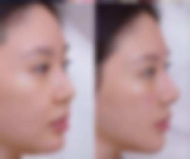 3d立体隆鼻的材料