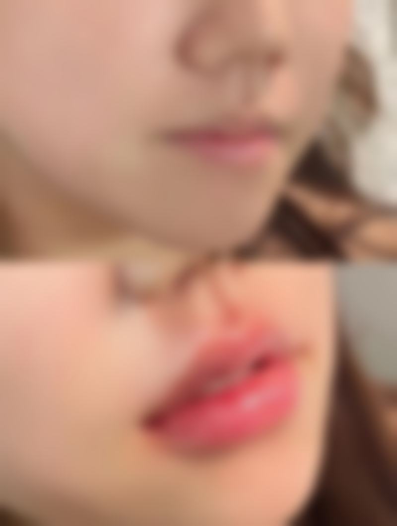 下颚骨整形修复期的注意事项