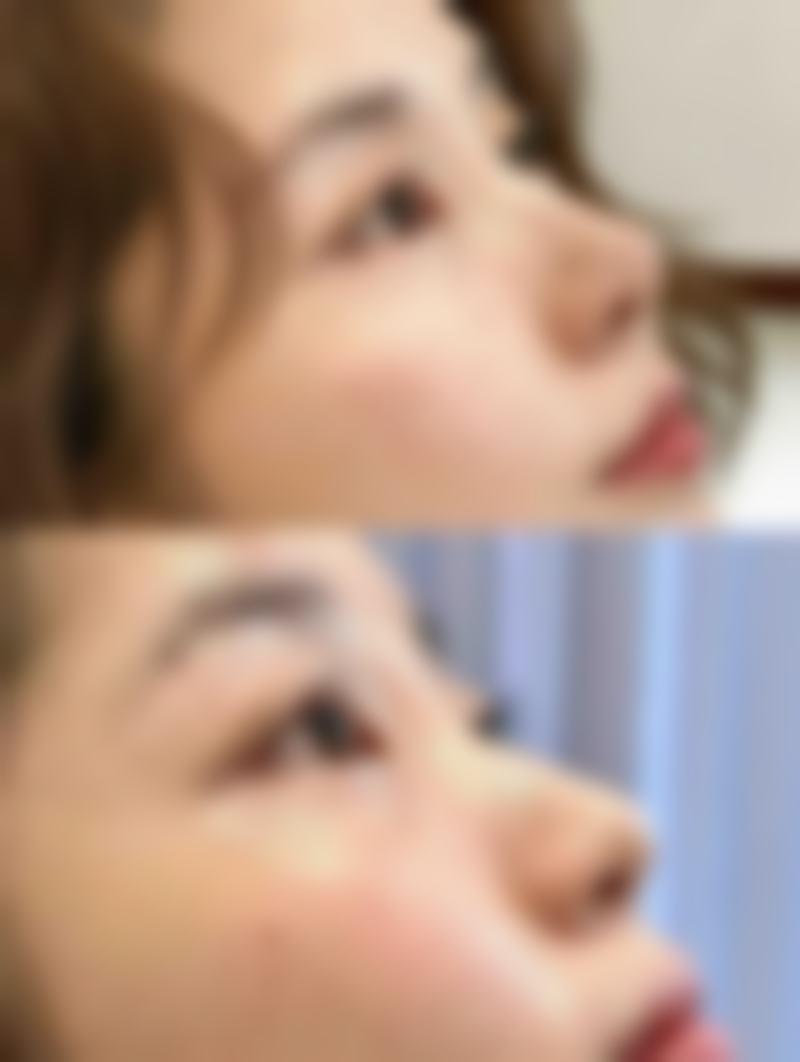 生活方式对去除眼袋的影响