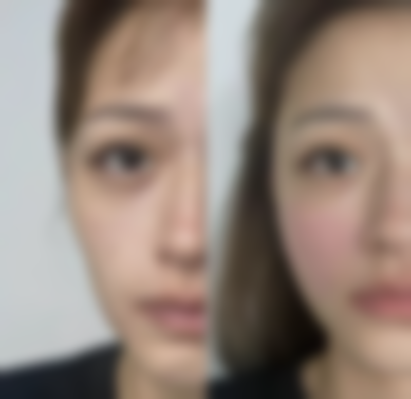 毛囊种植的方式