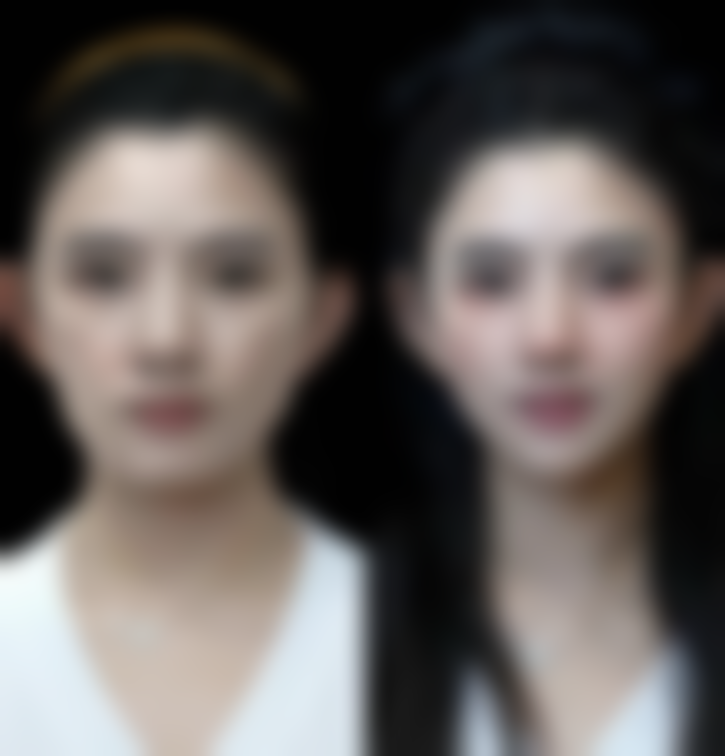 3d立体隆鼻是什么？它用硅胶定制鼻型，优势多费用4万起且医院各有特点 