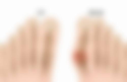 骨粉隆鼻不取出的危害