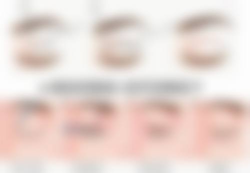 阴道紧缩术可修复分娩损伤