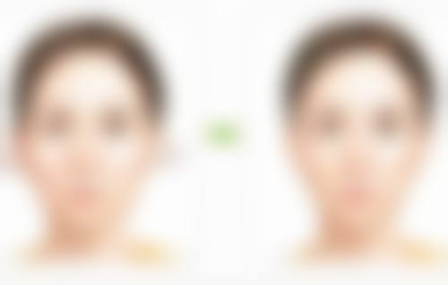 女性阴唇缩小手术前需要做哪些准备