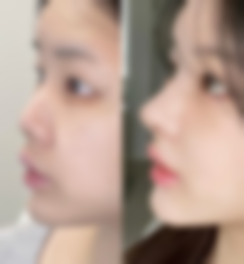 哪家自体脂肪丰臀好？从医生技术到地区机构多维度为你揭晓选择要点