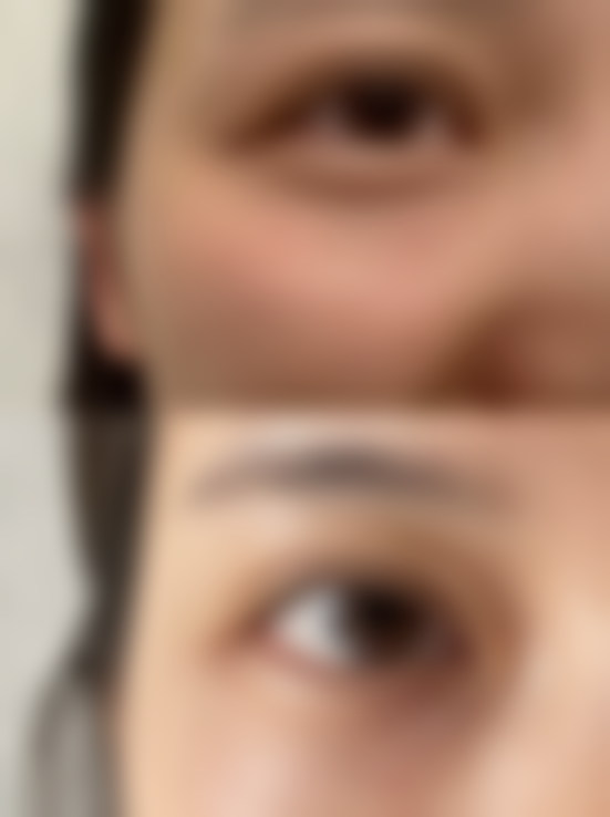 骨粉隆鼻不需要取出的情况