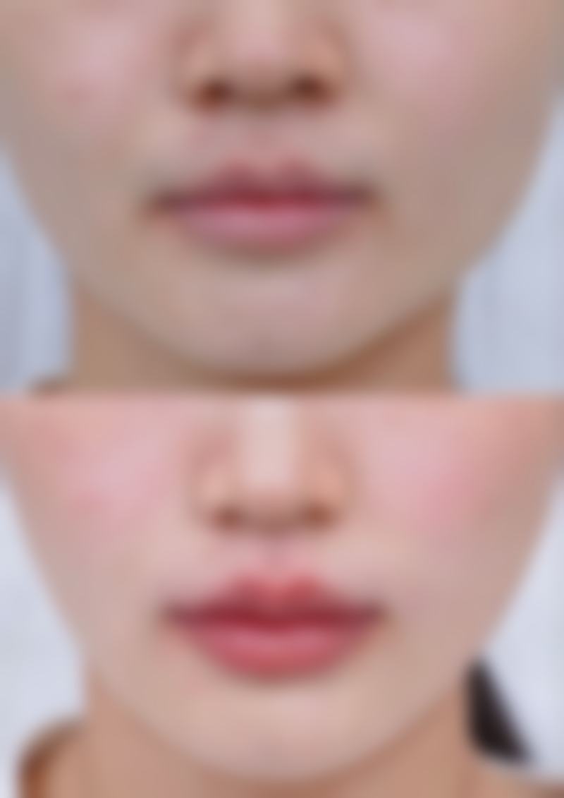 骨粉隆鼻需要取出的情况