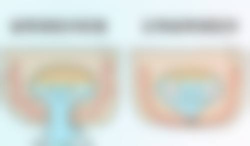 假体相关危害有哪些