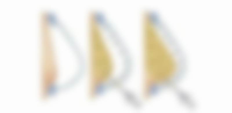 术后修复情况怎么样呢？