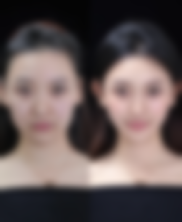 胶原蛋白注射丰太阳穴