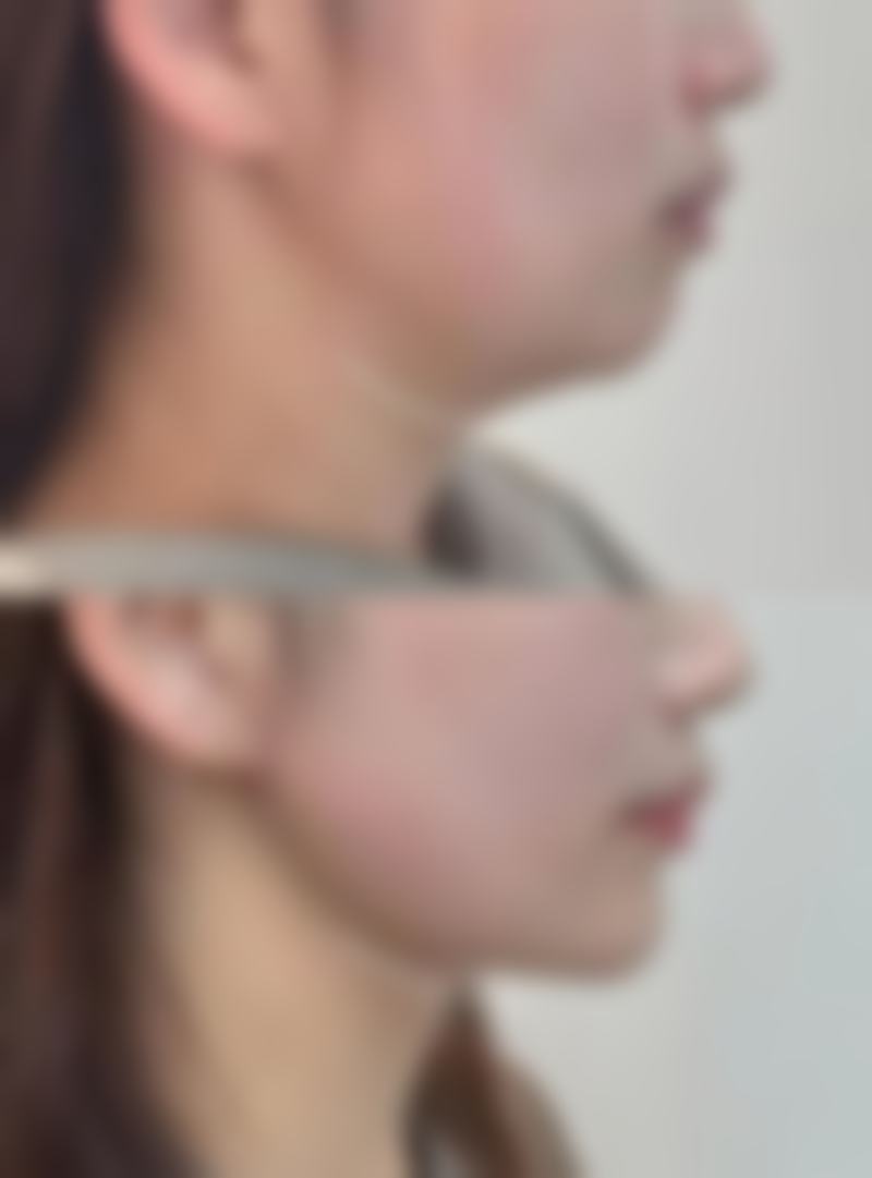 吸脂手术有什么危害？术中术后或有出血感染、皮肤松弛及心理落差等风险