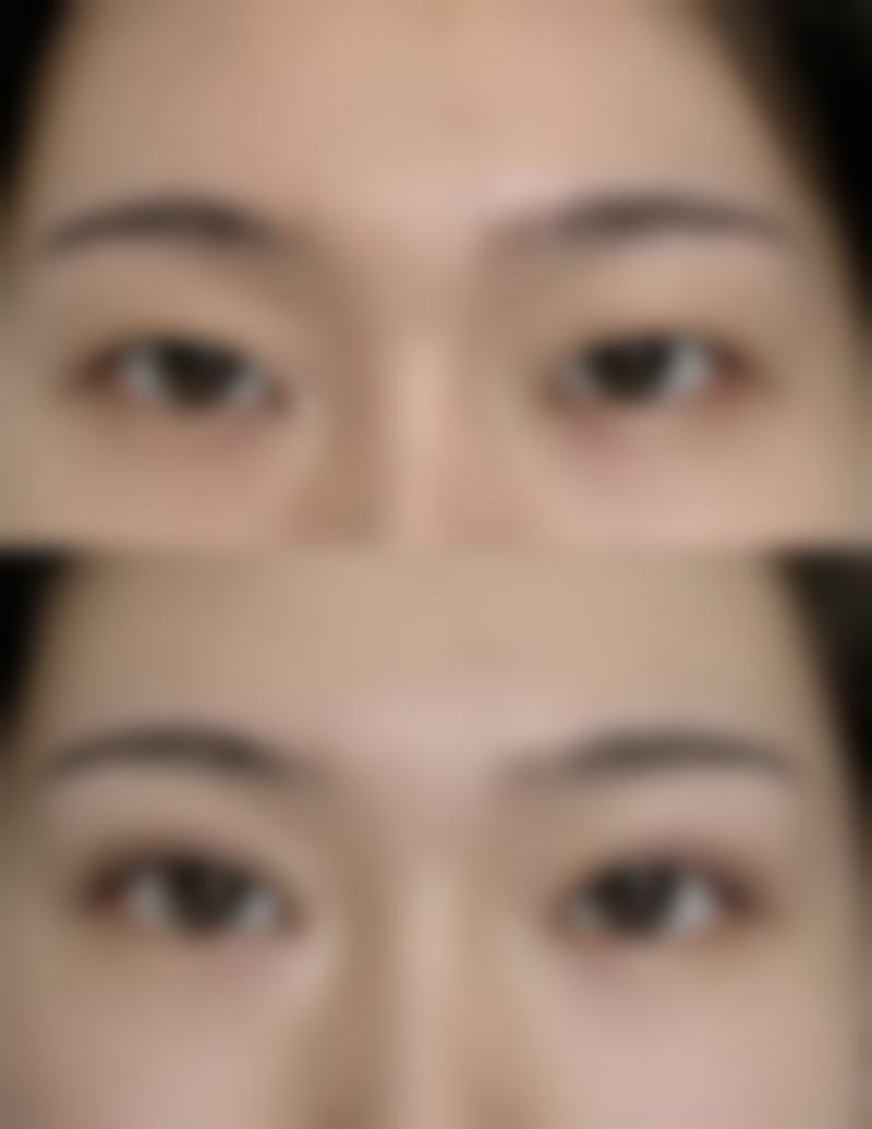 艾莉薇玻尿酸，韩国“黑科技”玻尿酸