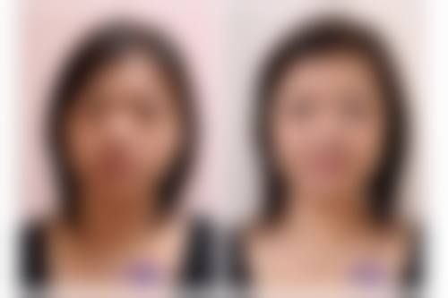 总结——洛阳班爱荣医疗整形美容诊所李浩浩医生怎么样？