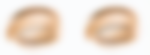 丰太阳穴重度并发症（虽然罕见但需重视）