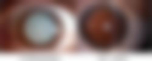 小腿抽脂手术好不好？优点缺点大揭秘，能否选择还得看个人情况