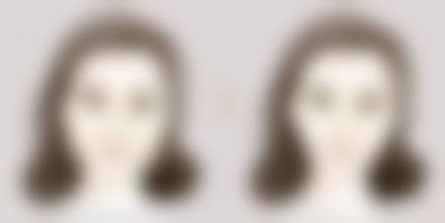 丰太阳穴有什么坏处？短期肿胀淤青、中远期移位结块，严重还会有栓塞感染！ 