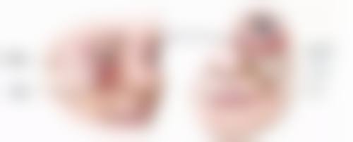 不同填充材料与风险的关联