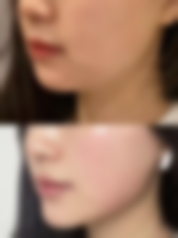 矫正后的护理与保持