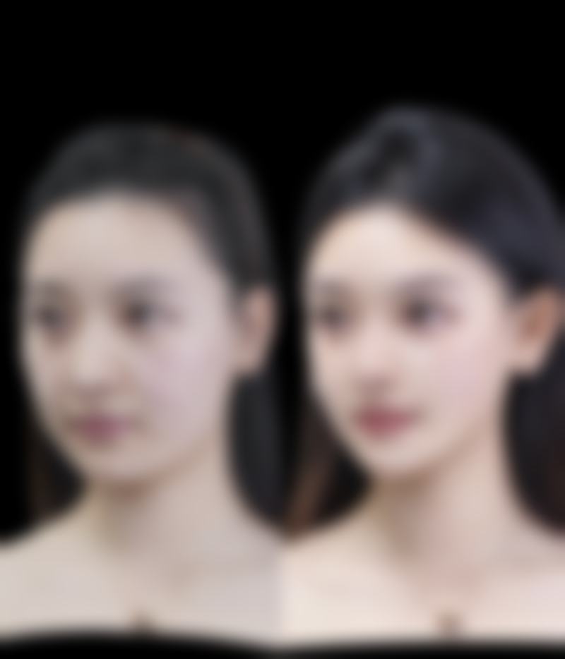 自体脂肪丰臀安全可靠吗？了解优势风险，选对医生做好护理是关键 