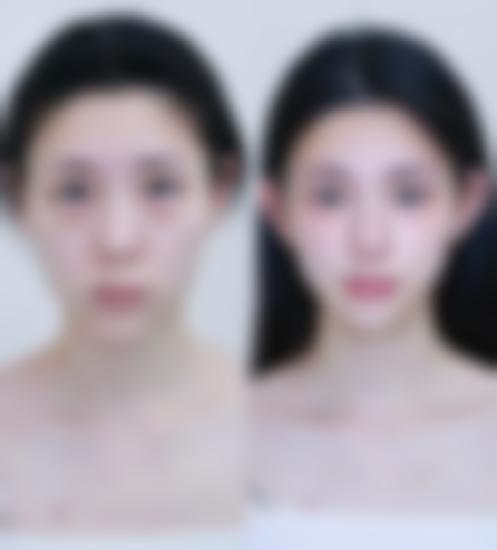 如何降低自体脂肪丰太阳穴的危险