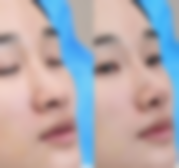 30岁隆鼻的注意事项