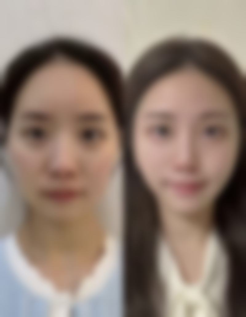 如何判断小腿抽脂手术好不好