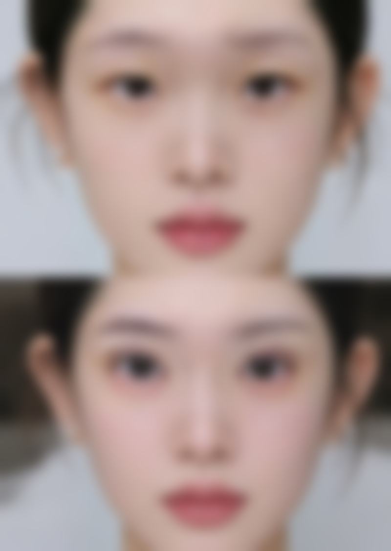 小腿抽脂手术的缺点