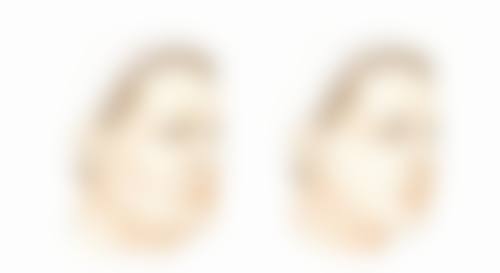 选择正规医院打黄盖美白针的重要性